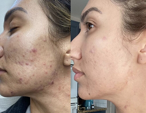 Microneedle rf treatment before after