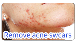 BA-FC23 removal acne swcars