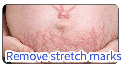 BA-FC23 removal stretch marks