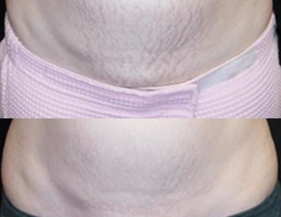 Scars Removal