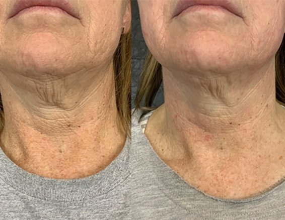Skin Lifting