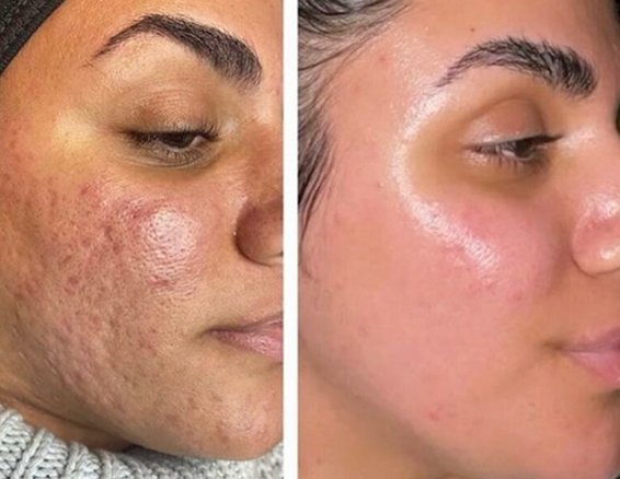 Skin Resurfacing