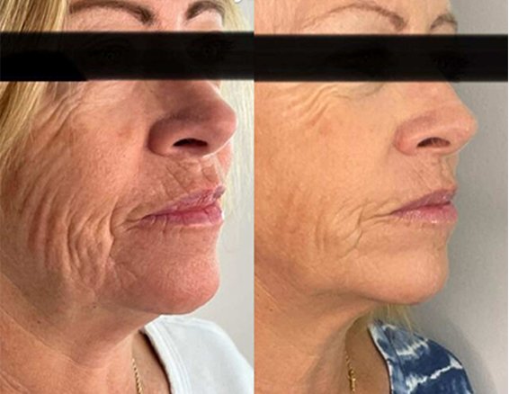 Wrinkle Removal