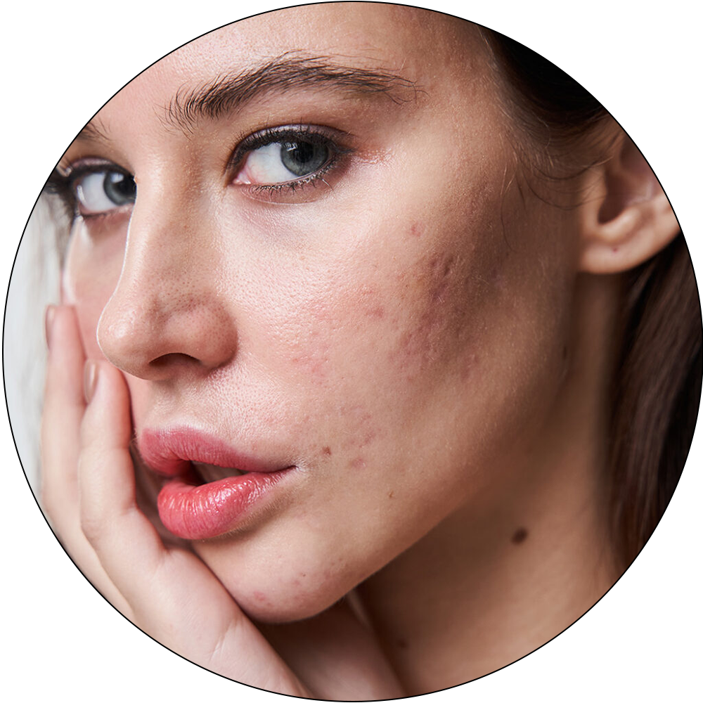 ba-pc21 picoway laser machine functions acne removal