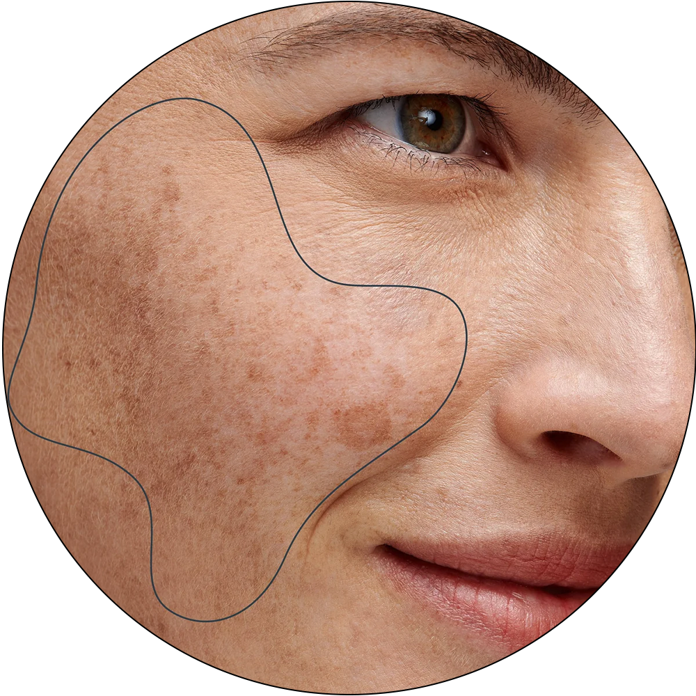 ba-pc21 picoway laser machine functions pigmentation removal