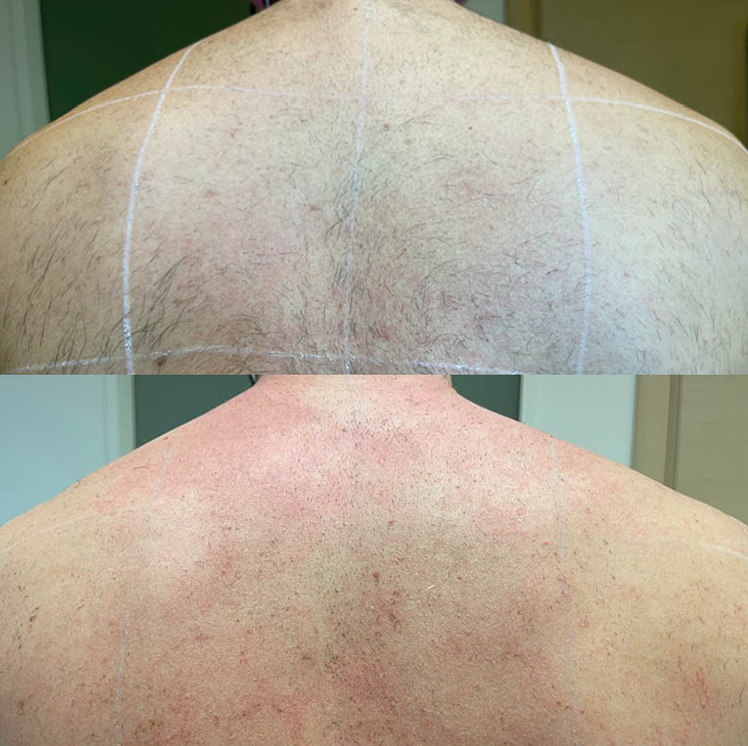 back bamlaser ice laser hair removal machine treatment display
