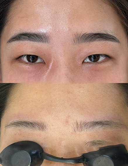 bamlaser picosecond laser machine treatment before after