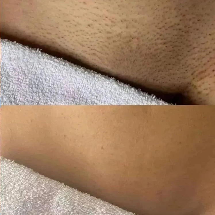bikini line laser hair removal machine bamboolaser