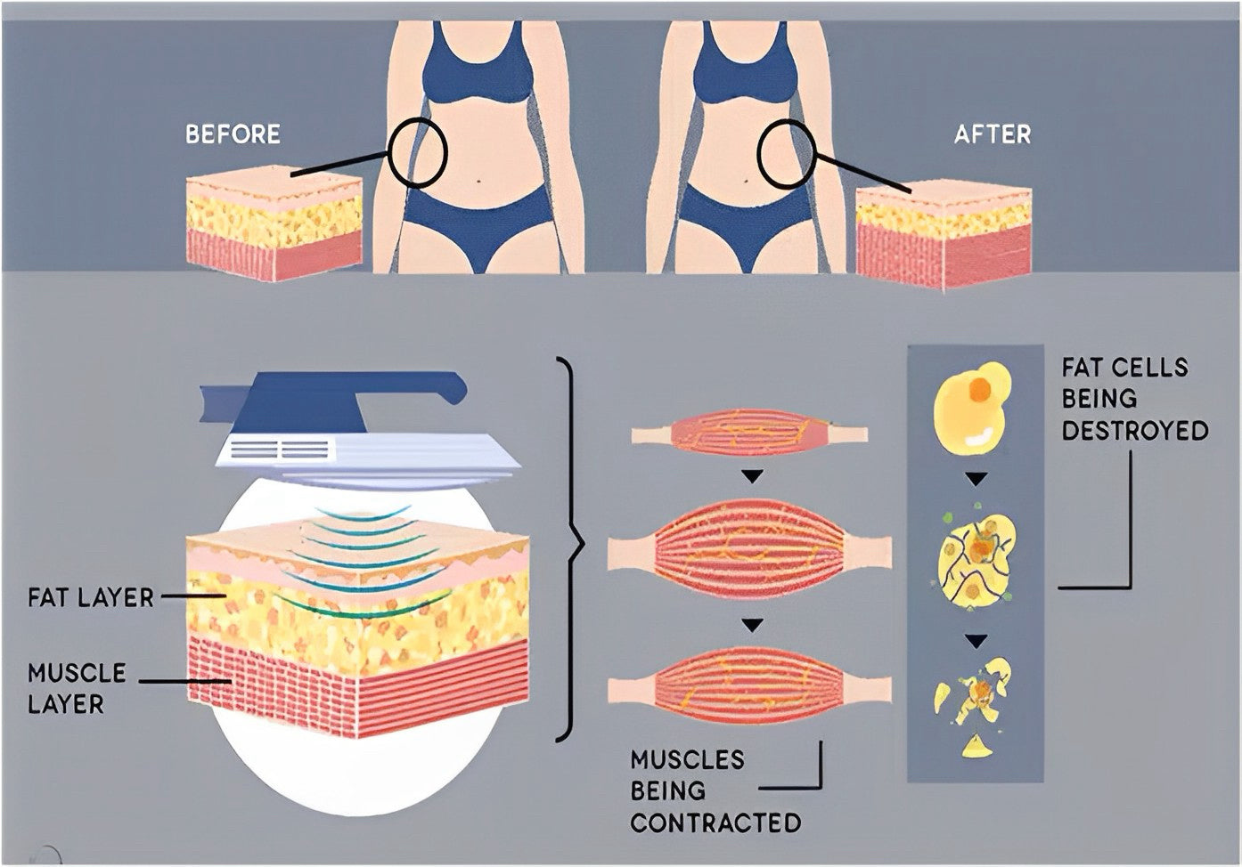 ems-body-sculpting-machine-archives-bamboolaser