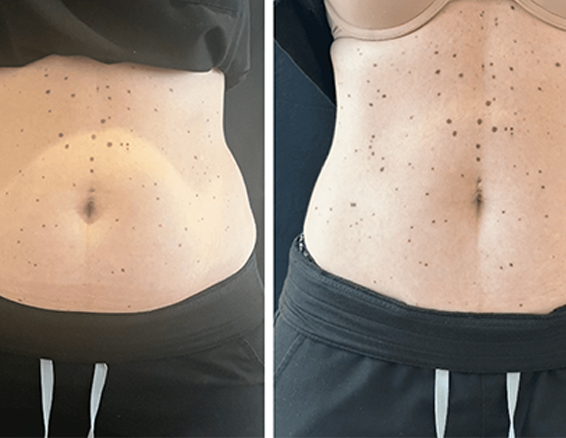 ems rf muscle building before after7