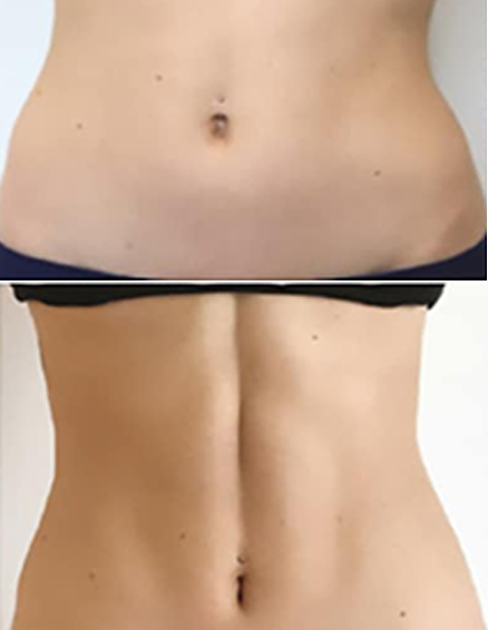 emszero treatment before after
