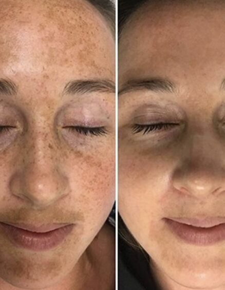 face pigments removal
