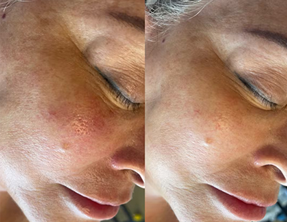 microdermabrasion