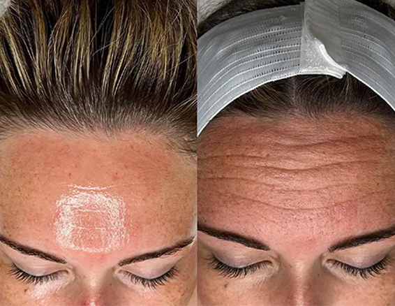 BA-HY23-microdermabrasion