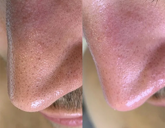 microdermabrasion