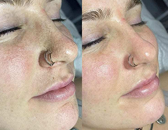 BA-HY23-microdermabrasion