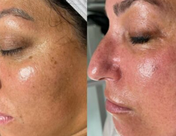 BA-HY23-microdermabrasion