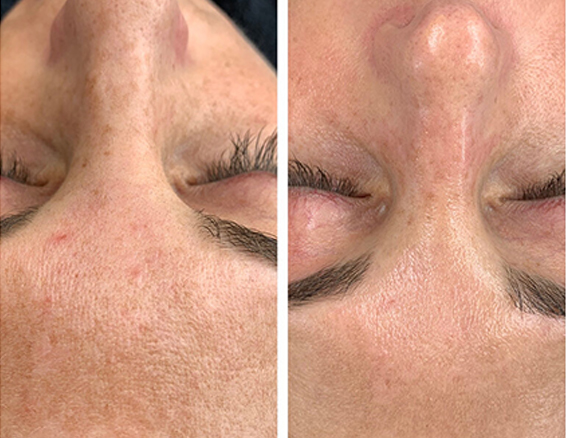 microdermabrasion