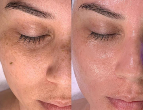 microdermabrasion