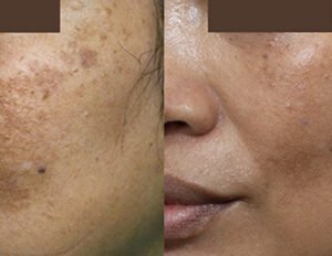 picosecond laser machine treatment before after111