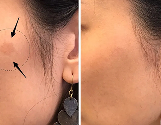 picosecond laser machine treatment before after1321