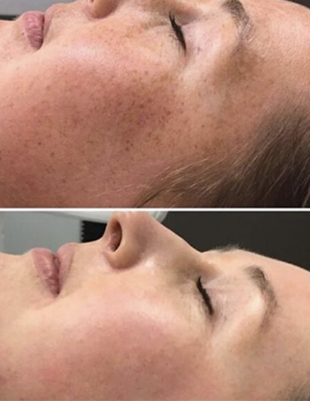 picosecond laser machine treatment before after13211