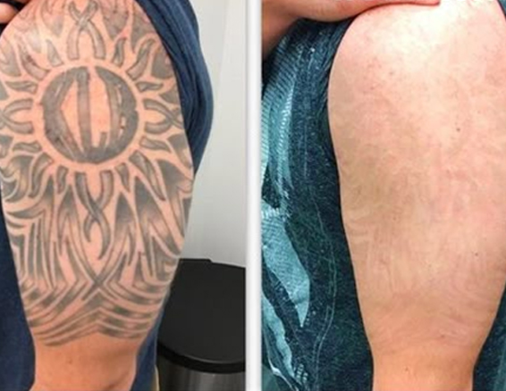 picosecond laser machine treatment before after456456