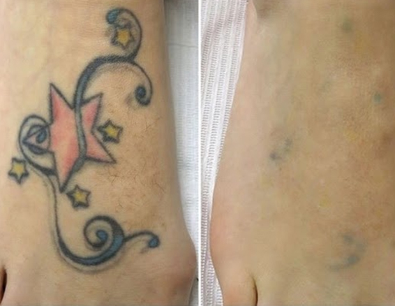 tattoo removal