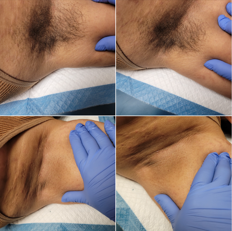 underarm laser hair removal