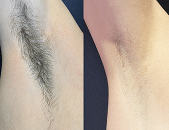 underarm
