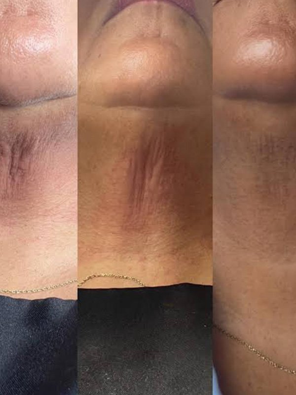 ba-fp22 fusion plasma before after