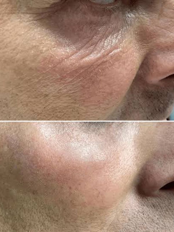 ba-fp22 fusion plasma before after