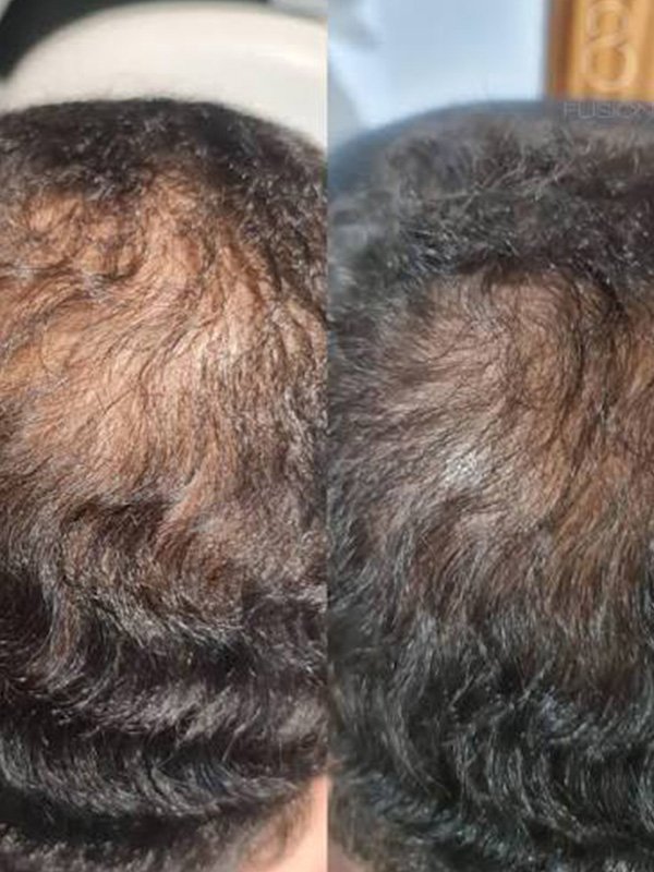 ba-fp22 fusion plasma before after