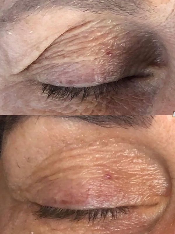 ba-fp22 fusion plasma before after