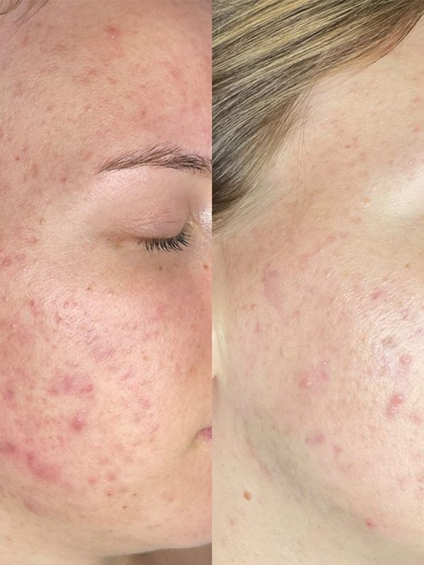 ba-fp22 fusion plasma before after