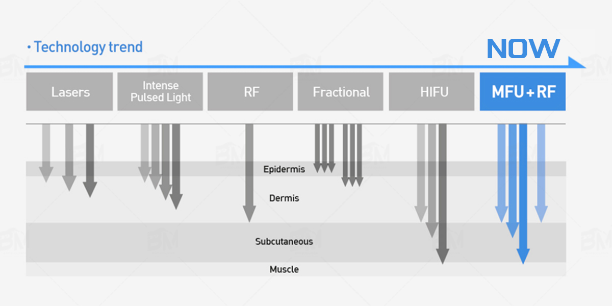 hifu machine technology trends