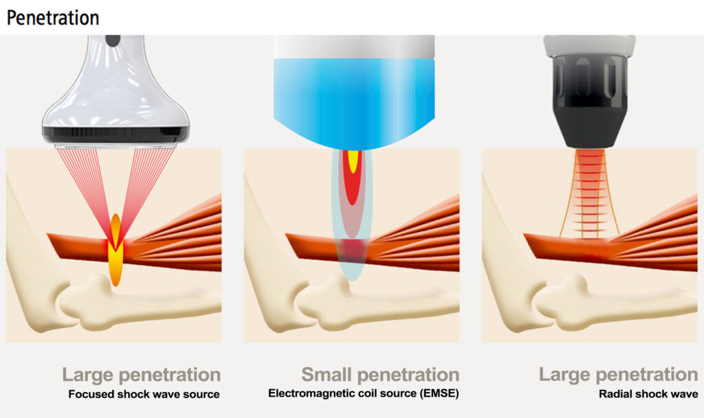 focused shockwave machine penetration compare