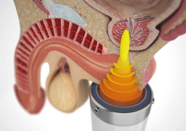 focused shockwave therapy for ed