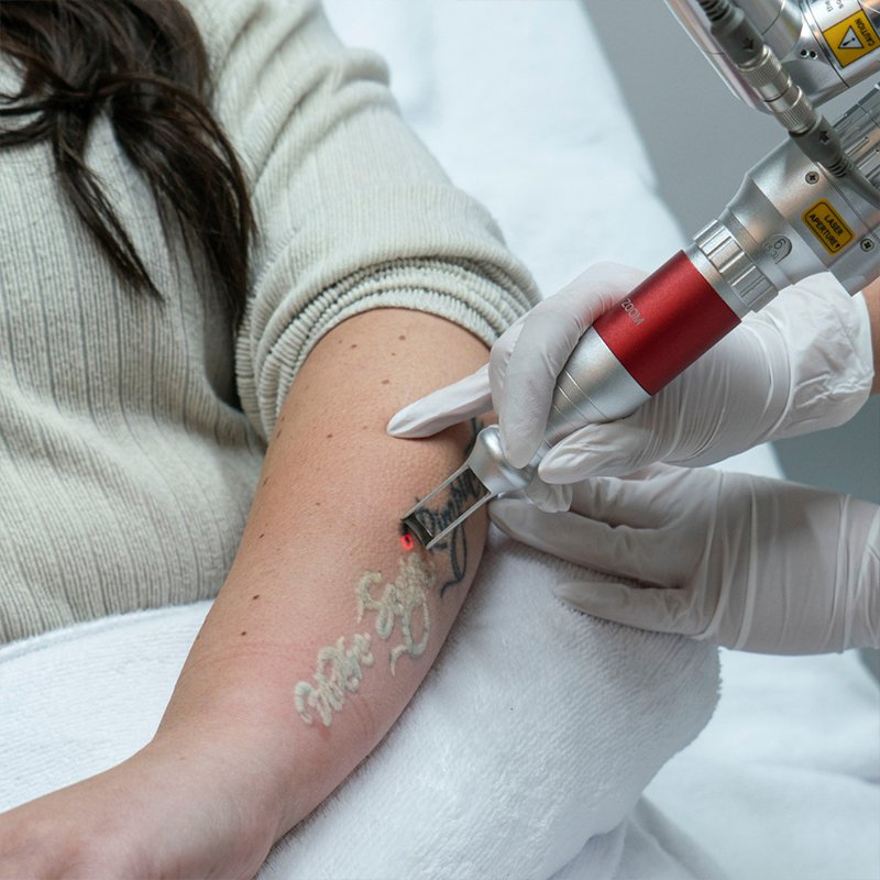 picosecond laser tattoo removal