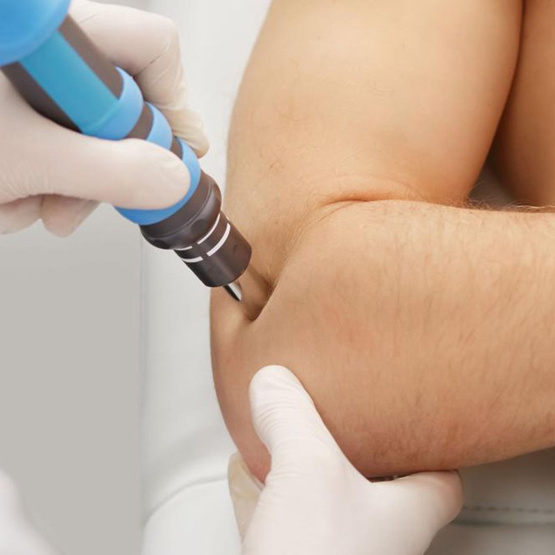 shockwave therapy