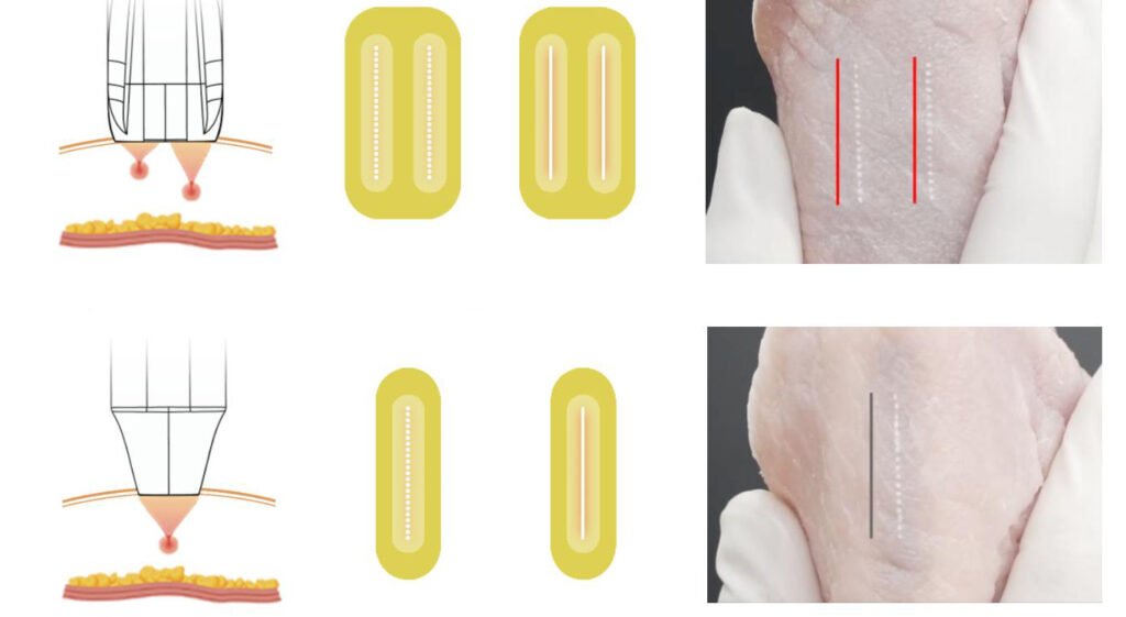 fusion hifu principle