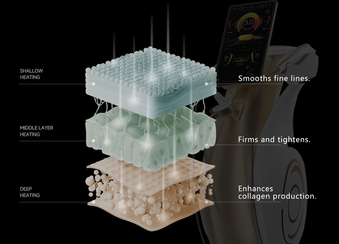mvs hifu machine principle