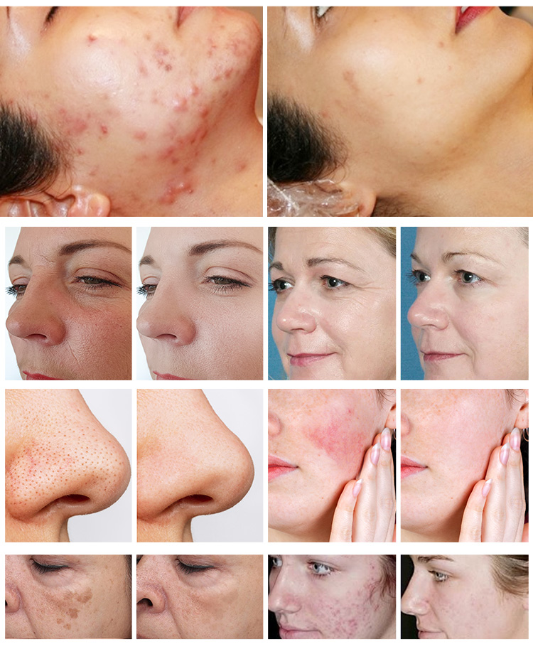 1927nm thulium laser before after