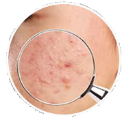 Acne Treatment
