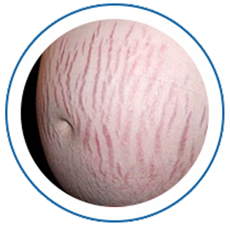 Eliminating pregnancy induced wrinkles