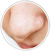 Enlarged Pores
