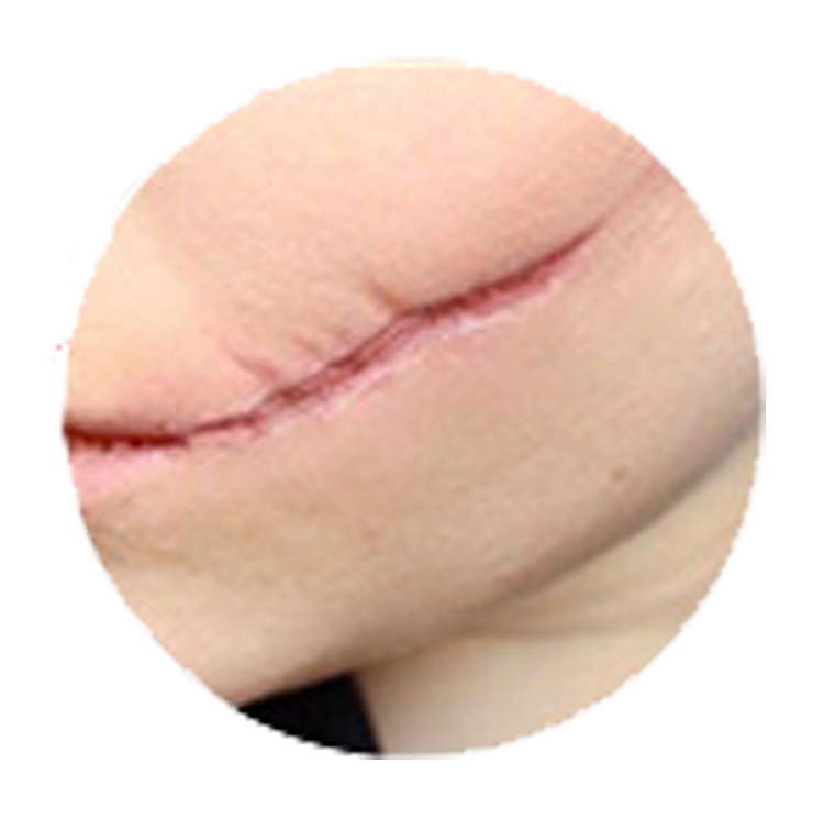 Remova Scars Stretch Marks