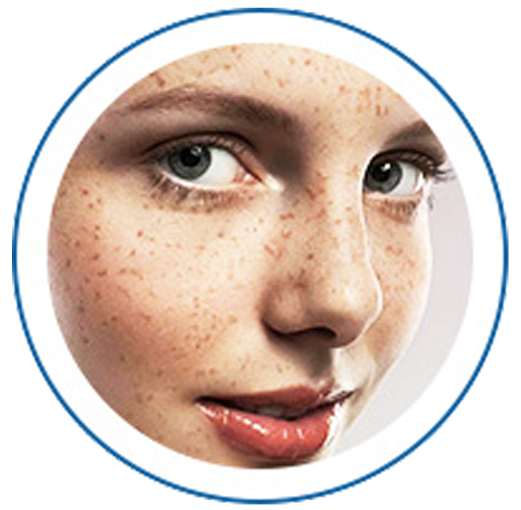 Remove of acne, treatment of pigmented lesions such as freckles