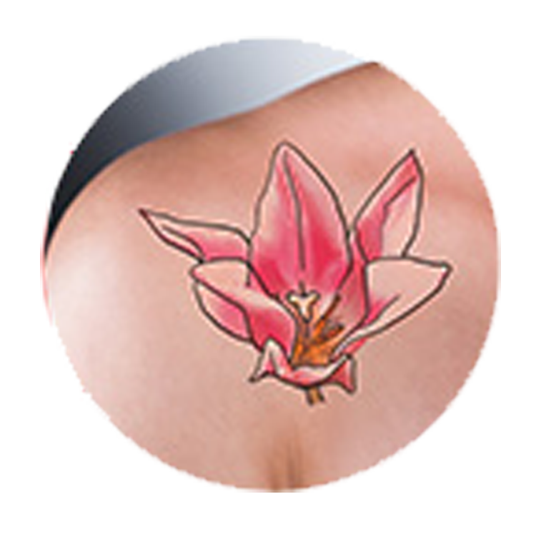 Tattoo Removal