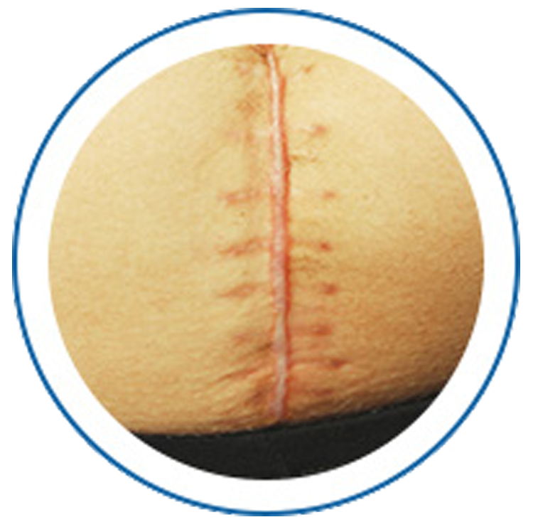Treating old and new scars